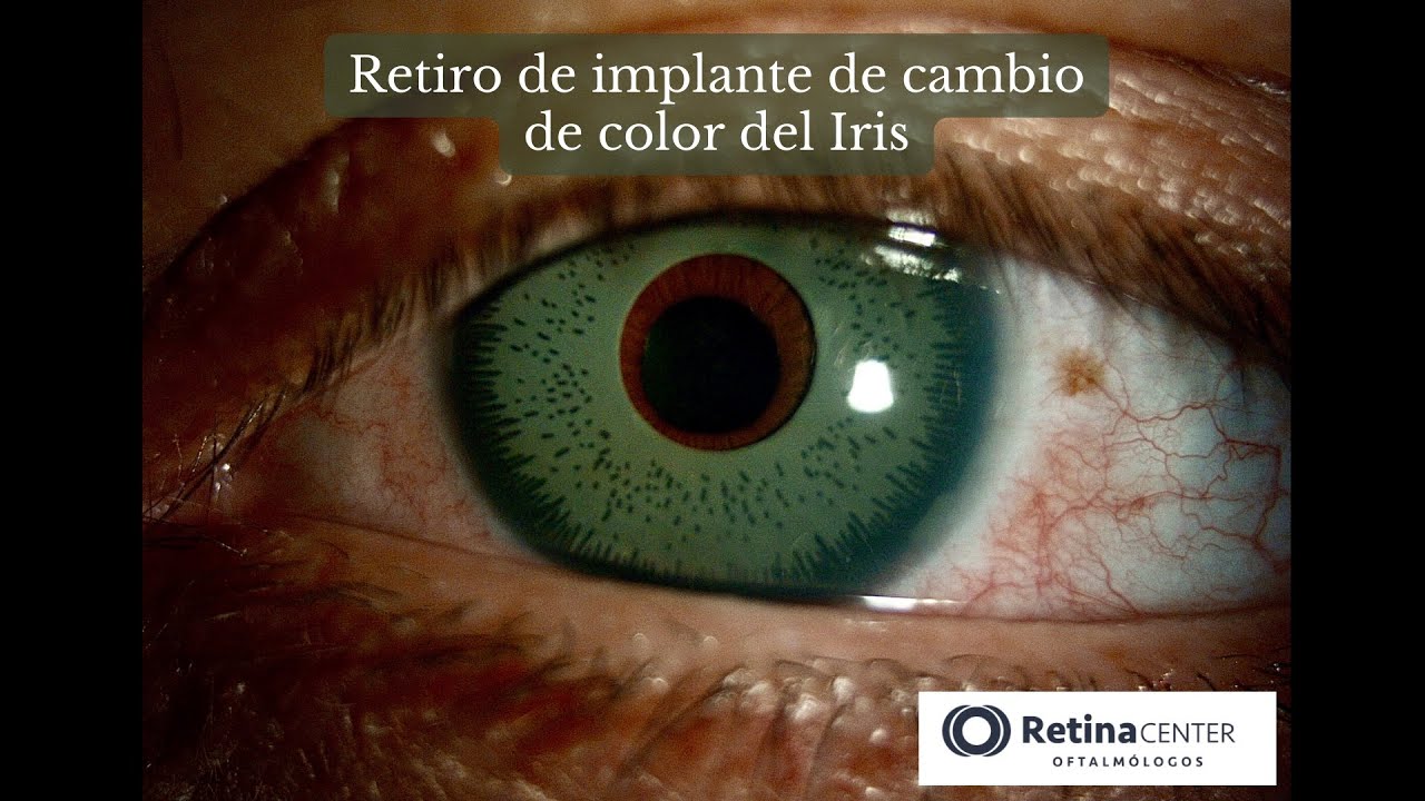 cuanto cuesta cambiarse los ojos de color